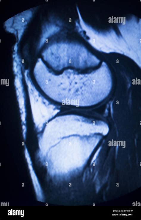 Oberschenkel Kniegelenk Querschnitt Fotos Und Bildmaterial In Hoher