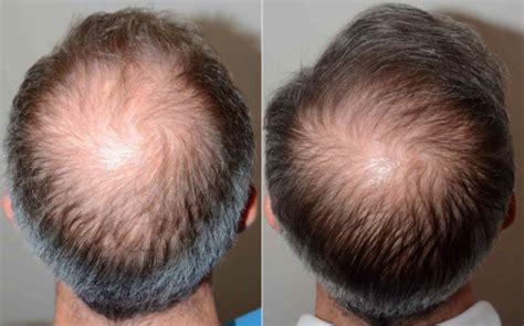 Hair Transplants For Men Photos Miami Fl Patient120543