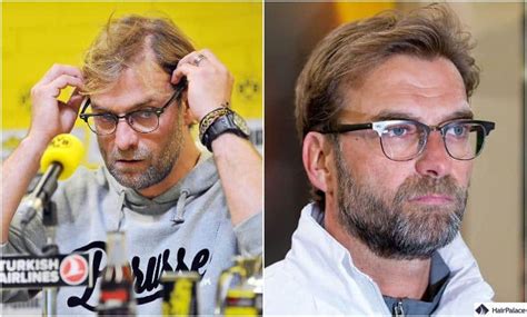 Jürgen Klopp Haartransplantation Geschichte des Trainers