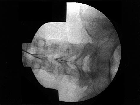 Percutaneous Cephalocaudal Implantation Of Epidural Stimulation Electrodes Over Sacral Nerve