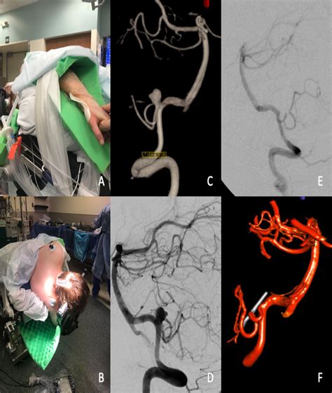 Transradial Intraoperative Cerebral Angiography A Multicenter Case