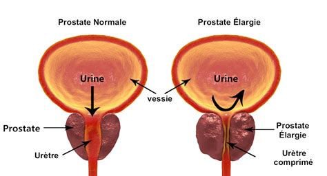 Comprendre Le Gonflement De La Prostate Et Son Traitement Mini Invasif