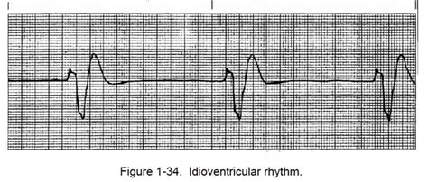 figure   idioventricular rhythm cardiac rhythm interpretation