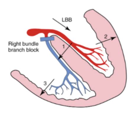 ECG: Bundle Branch Blocks Flashcards | Quizlet