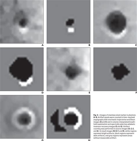 Figure From Comparison Of The Artifacts Caused By Metallic Implants