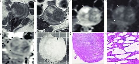 A 54 Year Old Woman With Uterine Adenomatoid Tumor Lesion 4 A A