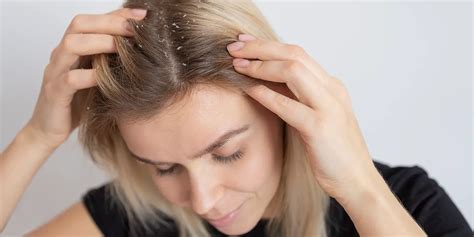 Dandruff Symptoms Causes And Treatment