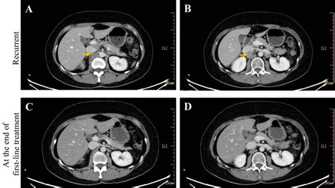 lymph nodes recurrent   aorta  inferior caval vein