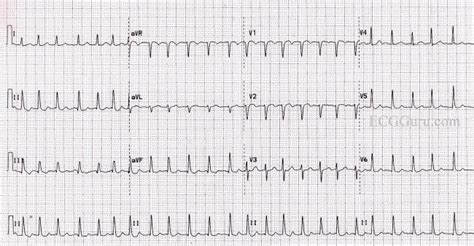 Rapid ventricular response | ECG Guru - Instructor Resources