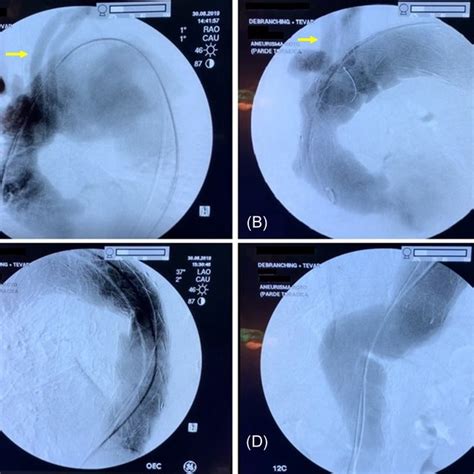 A, Large ascending aorta aneurysm. B, After wrapping the ascending ...