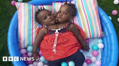 قصة التوأم الملتصق الذي لم يتوقع له أحد الحياة Bbc News عربي