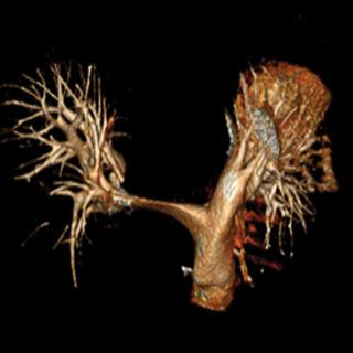 Three Dimensional Computed Tomography Reconstruction Of Pulmonary