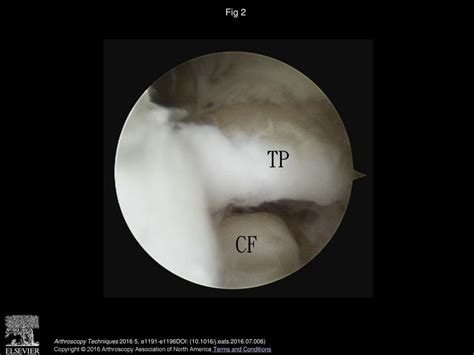 Decompression Of Posterior Ankle Impingement With Concomitant Anterior