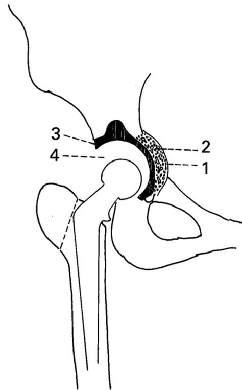 Acetabular Reconstruction In Patients With Low And High Dislocation Bone And Joint