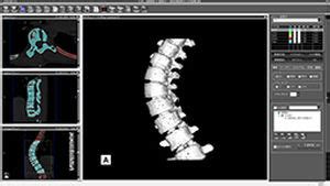 Logiciel M Dical Zedview Lexi Co Tdm Pour Chirurgie Du Rachis