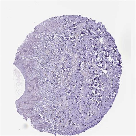 Tissue Expression Of Cd68 Staining In Skin The Human Protein Atlas