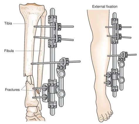 External Fixation Devices Med Institute