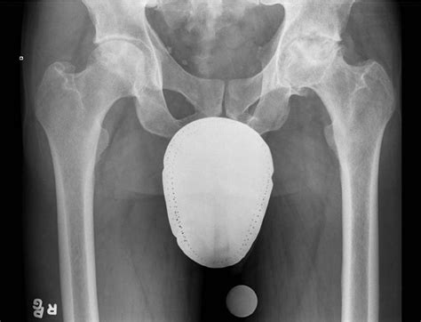 Osteonecrosis Of The Femoral Head Bone Joint