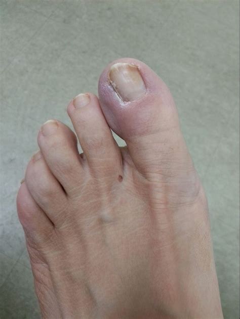 Ingrown Toenail — United Foot And Ankle Surgeons