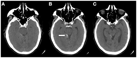 Ct Ac Demonstrating Sah In The Quadrigeminal And Supracerebellar