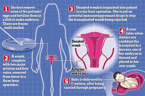 Us Hospital Cleveland Clinic Becomes The First To Offer Womb