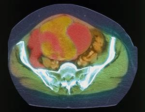 Intraperitoneal Chemotherapy Improves Survival in Ovarian Cancer ...