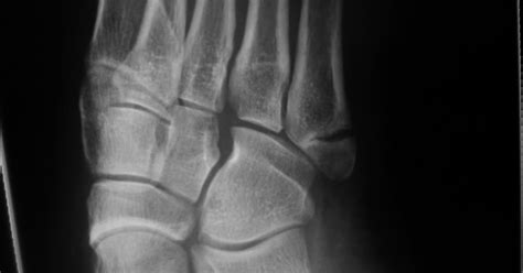 Fractured Metatarsal - Fracture Treatment