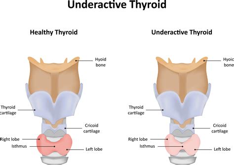 What foods make an underactive thyroid worse? | Total Health