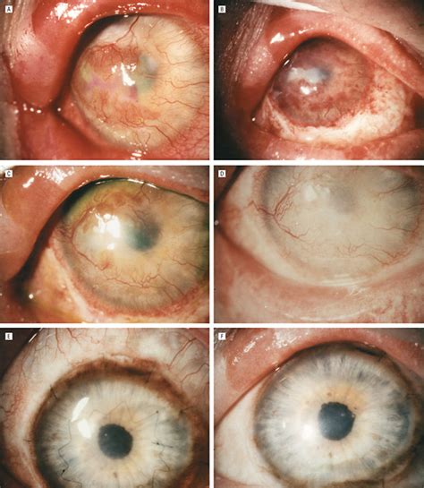 Amniotic Membrane Transplantation With Or Without Limbal Allografts For