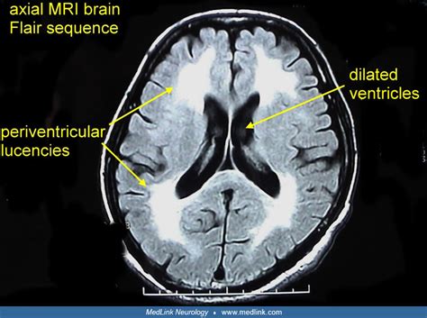 Subcortical Vascular Cognitive Impairment Medlink Neurology