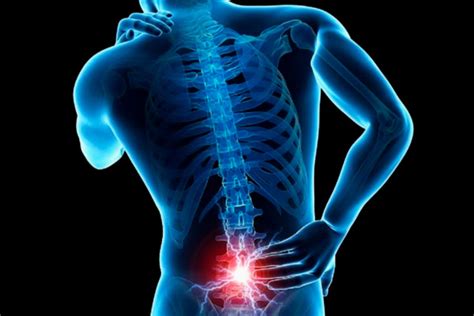 Qu Es El Dolor Lumbar Cirug A Neurol Gica