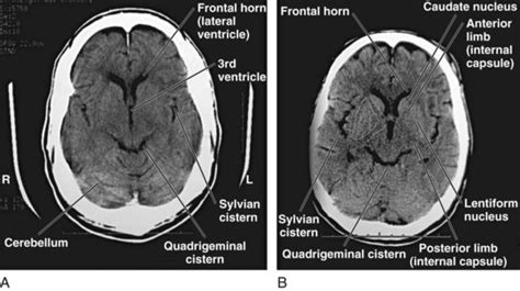 Quadrigeminal Cistern Anatomy