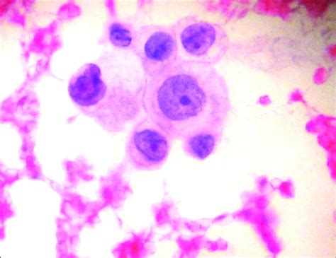 Cytospin Smears Of Csf From Case 1 Showing A Cluster Of Tumor Cells Download Scientific Diagram