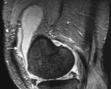 Anatomy And Mr Imaging Appearances Of Synovial Plicae Of The Knee