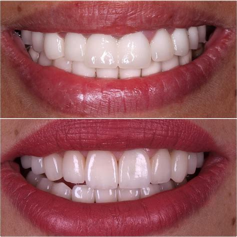 Thick and dull zirconia crowns were replaced with more natural looking ...