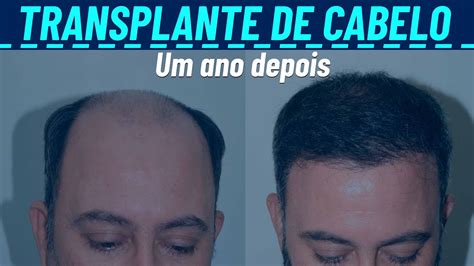 Transplante Capilar A Laser Bom Para O Bolso E Para Os Fol Culos