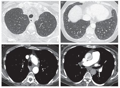 Pulmonary Veno-Occlusive Disease: A Comprehensive Review of Diagnostic ...