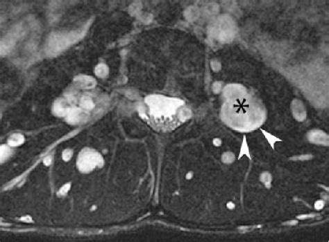 Figure 14 From Imaging Of Benign Soft Tissue Tumors Semantic Scholar