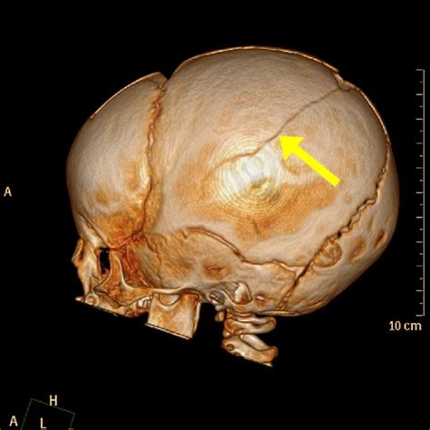 Showing blue sclerae evident in patient | Download Scientific Diagram