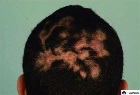 Scalp Infections | Types, Symptoms, and Treatments (2023)