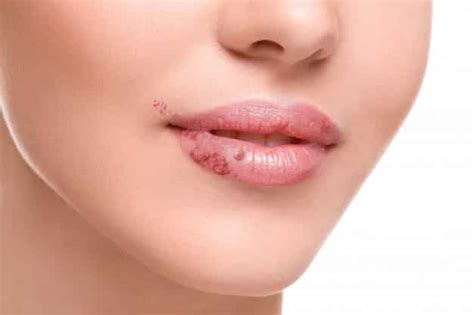 Herpes Labial Causas S Ntomas Y Tratamiento Interoralia