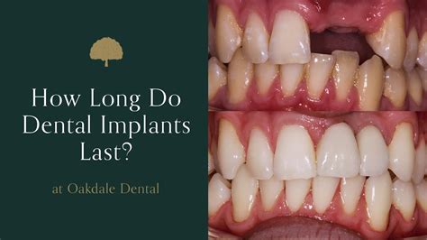 How Long Do Dental Implants Last Dental Clinic