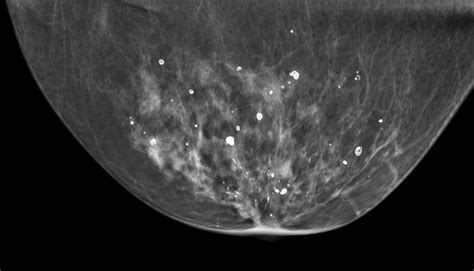 Mammographic Microcalcifications and Risk of Breast Cancer | Cancer Community