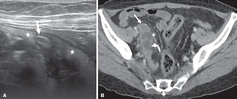 Scielo Brasil Mucocele Of The Appendix What To Expect Mucocele Of