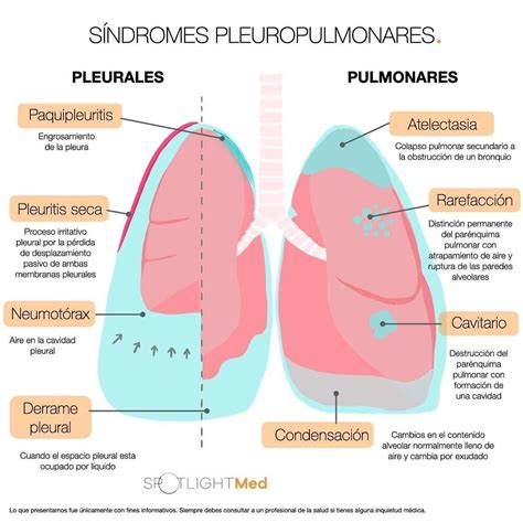 Síndromes Pleuropulmonares Diagnosticos de enfermeria Cosas de