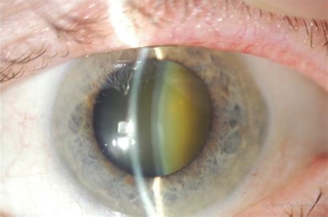 Cataracts – Symptoms – Terrace Eye Centre