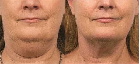 Best Double Chin Treatments 2024 Cutis Dermatology