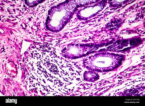 Ad Nocarcinome Intestinal Bien Diff Renci Micrographe L Ger Photo