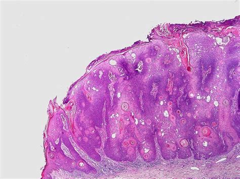 Inverted follicular keratosis - Alchetron, the free social encyclopedia