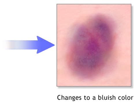 How To Help Bruises Heal | Examples and Forms